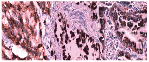 Figure 2. Immunohistochemistry staining: Napsin A, TTF-1, CK7 was positive respectively.