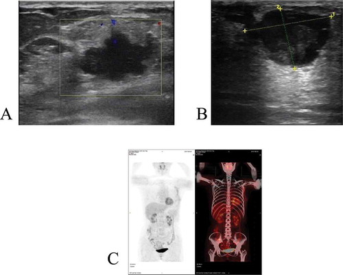 Figure 1. (a) Ultrasonographic examination of the left breast showed an irregular-shaped hypoechoic lesion measuring 2.2 × 1.4 cm with an internal heterogeneous anechoic area(case 1); (b) Ultrasonographic examination of the right breast showed an irregular-shaped hypoechoic lesion measuring 2.5 × 2 cm with an internal mixed echo and punctiform strong echo(case 2); (c) The postoperative PET-CT show no mass lesion in other parts(case 1)