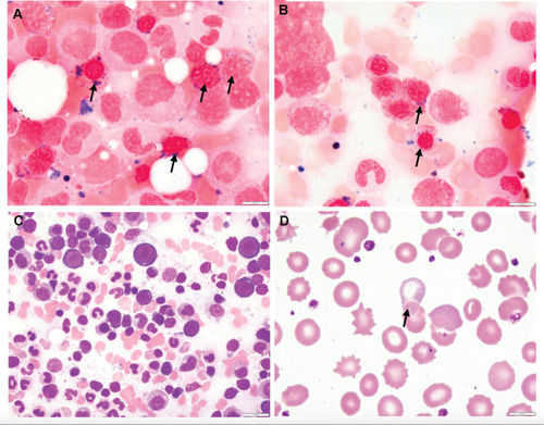 Figure 1 Bone marrow and peripheral blood histomorphology in sideroblastic anemia from a 65-year-old female with XLSA (A and B) Iron-stained bone marrow aspirate showing ring sideroblasts by the presence of iron granules (blue) in a perinuclear ring formation in erythroblasts (black arrows indicate the ringed sideroblasts). (C) H&E stained bone marrow aspirate showing several erythroblasts and myeloid precursors. (D) Wright-Giemsa stained peripheral blood smear showing basophilic stippling of a hypochromic red blood cell (black arrow indicates the presence of a red cell with basophilic stippling). The red cell morphology is defined by microcytosis, anisocytosis and poikilocytosis. Echinocytes are additionally present.