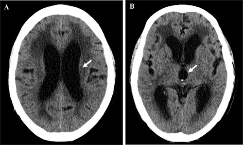 Figure 5 Brain CT scans depicting hydrocephalus. (A) Exhibited a dilated lateral ventricle (arrow). (B) Showed an expanded 3rd ventricle (arrow).