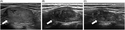 Figure 3. US images of a solid thyroid nodule developed after previous thyroid surgery. (A) The longitudinal US showed a benign nodule located in the left lobe. (B) At 3 months after RFA, the volume reduction rate was 67.71%. (C) At 12 months after RFA, the volume reduction rate was 72.99%.