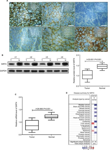 Figure 1 SIRT4 protein expression in tissues.Notes: (Aa) Expression of SIRT4 in adjacent normal tissues; (Ab) expression of SIRT4 in neuroblastoma (NB) tissues; (Ac) negative expression of SIRT4 in NB tissues (–); (Ad) weak positive expression of SIRT4 in NB tissues (+); (Ae) positive expression of SIRT4 in NB tissues (++); (Af) strong positive expression of SIRT4 in NB tissues (+++); (B) T = neuroblastoma tissues, N = adjacent normal tissue, nx = number x of patient with NB; (C) relative expression levels of SIRT4 mRNA in tissues as shown by real-time fluorescence quantitative PCR; (D) Oncomine website search results of SIRT4 gene in cancer tissue vs normal tissue. Blue indicates that SIRT4 gene expression was downregulated compared to the normal tissue and red indicates that gene expression was upregulated. P-value was set to <0.05. Threshold (fold change) was set to 1.5. Threshold (gene rank) was set to top 10%. Data type was set to all. Scale bars =50 µm.