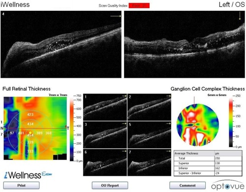 Figure 8 Category 2 subject (J728) with severe retinal distortion, interfering with retinal segmentation and ganglion cell complex thickness map and measurements.