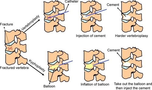 Figure 1 Schematic of vertebroplasty and kyphoplasty procedures, which are both minimally invasive, percutaneous surgical approaches that can internally stabilize a fractured vertebral body via injection of self-hardening biomaterials like bone cement.Note: The difference between vertebroplasty and kyphoplasty procedures is the utilization of a balloon that is inflated to create a cavity in the compressed vertebral body prior to injection of the cement. The blue lines represent the catheter; the yellow ovals represent the balloon; and the white oval represents the cement in each instance.