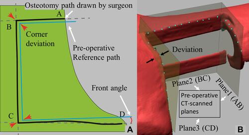 Figure 6 Definitions of terminology to measure errors: (A) the “corner deviation” is defined as the displacement error at the corner B or C between the CT-scan reference and the osteotomy lines drawn by a surgeon in the coronal plane, as shown. The “front angle” is the angular displacement of the AB or CD line segment between the CT-scan reference and the best-fit line of the drawn path in the coronal plane, as illustrated with CD line segment in the figure. (B) Many points on the resected bone surface corresponding to line segments AB, BC, and CD are sampled. Each sampled point, as shown, has a distance from the reference preoperative CT-scanned planes extended by AB, BC, CD lines (cf. plane 1, 2 and 3 in Figure 1B), respectively. The “max deviation” is defined as the maximum distance of deviation among all sampled points with a deviation (as shown), with respect to each corresponding plane. The results of maximum deviation are listed in Table A3 in the Appendix.