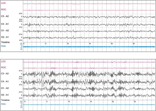 Figure 2. 30 second epochs of NonREM 2; upper panel: patient with insomnia using daily zolpidem (5–10 mg) for 18 years; note more or less ‘healthy’ EEG; low voltage, mixed frequency; alpha/theta range, with diffuse activity in the sigma range, though without pronounced spindles; lower panel: patient with insomnia using daily diazepam (5–10 mg) or brotizolam (0.25 mg) for 15 years; note additional ‘finger-print like’ excessive occurrence of spindle activity; often still to be detected months after benzodiazepine withdrawal