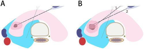 Figure 3. The fixed-needle technique (A) and moving-shot technique (B) adopted to ablate PTMCs and surrounding tissues.