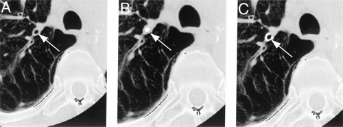 Figure 12 Quantification of airways disease. Source: (Citation[198]), Fig. 1, p. 1103. A representative case showing the process of airway analysis. Using a helical CT image containing the apical bronchus to the upper lobe (A), the algorithm defines the luminal area (B) and wall thickness (C).