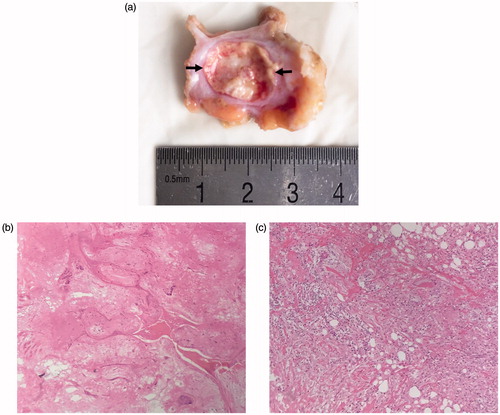 Figure 2. Macroscopic appearance of excised specimen after surgery (a) and HE staining (100×) of ablative area (b) and surrounding tissue (c) in 42-year-old woman. (a) The ablated area (arrow) is easily identified. (b) The ablated tumour is replaced by the stroma, and seldom nucleus is observed. (c) The surrounding tissue of the ablated tumour shows inflammatory cells infiltration.