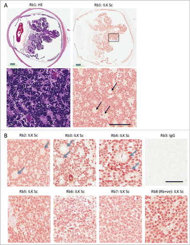 Figure 1. ILK expression in Rb positive and Rb deficient retinoblastoma. (A) Sections of retinoblastoma tissue taken from 8 different patients that were Rb mutant (Rb1–7) or Rb positive (Rb8). Serial sections of Rb mutant retinoblastoma tissue were stained with haemoxylin and eosin (HE) or with a monoclonal antibody to ILK (ILK Sc). The area enclosed by the black box in the low magnification view (upper) is shown at a higher magnification below (lower). Black arrows depict Homer Wright rosettes seen in well-differentiated retinoblastoma tissue and other tumors of neuronal origin. Calibration bars represent 3 mm (upper) and 100 μm (lower) (B) Immunohistochemical staining of well differentiated retinoblastoma tissue (P2–4) or more undifferentiated tissue (P5–8) for ILK. Well-differentiated tissue exhibit classic Flexner-Wintersteiner rosettes, characteristic of retinoblastoma (blue arrows) while Rb positive tissue (P8) have a preponderance of undifferentiated cells. Calibration bar represent 50 μm.