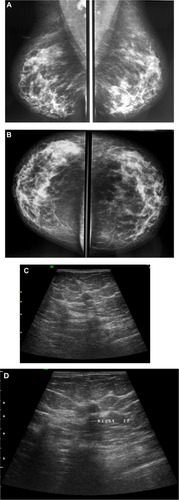 Figure 2 A 48-year-old female patient presented with palpable right axillary lymph node. (A and B) Craniocaudal and mediolateral mammogram revealed asymmetric breast density with no definite masses. (C and D) Ultrasound revealed three small hypoechoic masses at 1–11 o’clock of the right breast (only two are displayed here).