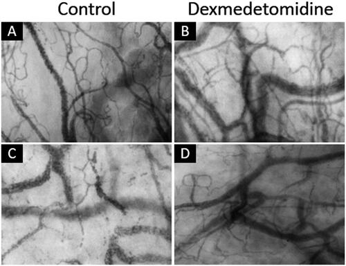 Figure 3. Sublingual microcirculation images at 2 h after surgery. (A and B) represent good microcirculation in one control group patient (PVD: 25.9 mm/mm2) and one dexmedetomidine (Dex) group patient (PVD: 25.8 mm/mm2). (C and D) represent fewer perfused vessels in one control group patient (PVD: 22.7 mm/mm2) and one dexmedetomidine group patient (PVD: 22.8 mm/mm2). PVD, perfused vessel density.