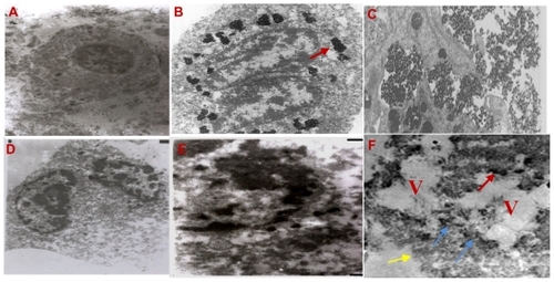 Figure 5 Transmission electron microscope pictures (2.4 μm) of subcutaneous EAC (A) control, (B and C) after injection by core shell NPs and (D–G) after (laser + RF irradiation) one, three, and six sessions of treatments, respectively.Abbreviations: EAC, Ehrlich ascites carcinoma; NPs, nanoparticles; RF, radio frequency.