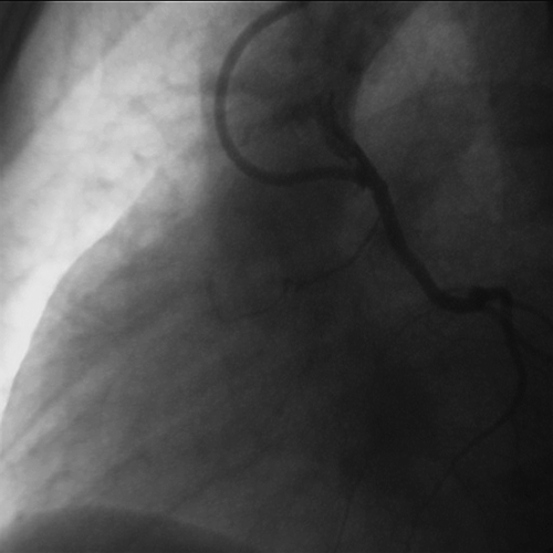 Figure 5 Six months angiographic follow‐up.