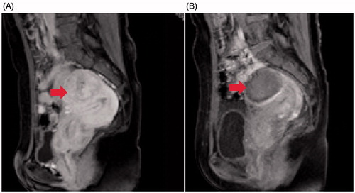 Figure 4. Contrast-enhanced MR images obtained from a patient with a retroverted uterus. (A) A pre-procedure contrast-enhanced MR image showed a 4.1 × 3.8 × 3.7 cm fibroid located at the anterior wall of the uterus (arrow). (B) Contrast-enhanced MRI obtained 1 day after HIFU showed the non-perfused volume ratio was 100% (arrow).