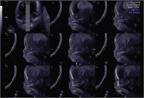 Figure 32.  Tomographic ultrasound image of fetal profile with hypoplastic nasal bone at the end of 13 weeks of gestation. Thinly sliced parallel cutting section of mid-sagittal plane shows fetal profile in detail and hypoplastic nasal bone. Trisomy 21 was confirmed by CVS.