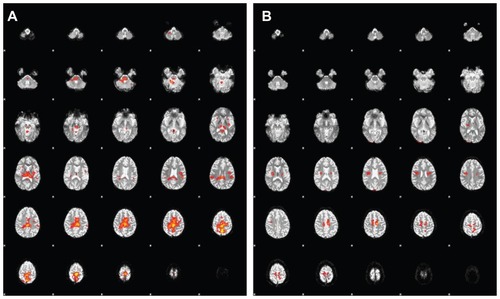 Figure 2 Average of functional magnetic resonance imaging (fMRI) scans from nine subjects before (A) and after (B) radioelectric asymmetric conveyer neuro-postural optimization (REAC-NPO).