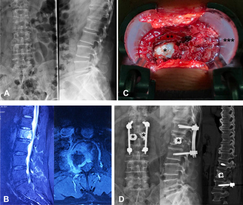 Figure 2 Illustration of minimally invasive tubular surgery. (A) Preoperative X-ray showing bone destruction of L2 vertebra. (B) Preoperative MRI showing metastatic epidural spinal cord compression due to collapsed L2 metastatic lesion. (C) minimally invasive decompression was performed through an expandable tubular retractor. (D) Postoperative X-ray, and CT scan were showing the decompression site and implants. (asterisk *, bone cement; double asterisk **, dural sac; triple asterisk ***, cephalic).