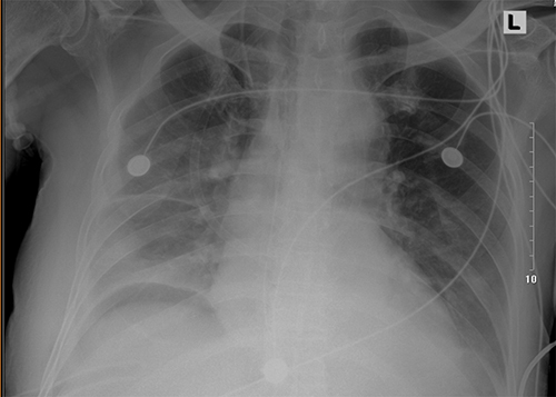 Figure 1 Chest X-ray obtained after 3 days in the ICU. Notable for pleural effusion in the right.