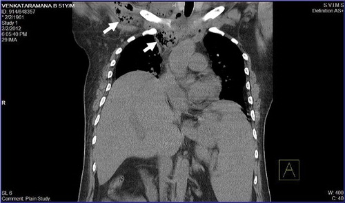 Figure 1.  Computed tomography (plain) showing abscess in the chest wall extending to mediastinum with multiple air pockets.