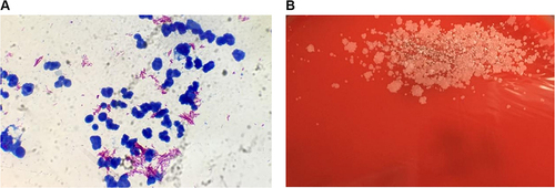Figure 4 Ziehl-Neelsen staining and isolate of Mycobacterium abscessus on blood agar. (A) Ziehl-Neelsen staining was used to test drainage fluid and wound secretion samples, which showed a positive result with red bacillus against a blue background. (B) After culturing for several days, rough and colorless colonies with varying sizes of M. abscessus were isolated.
