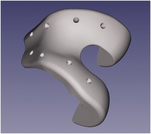 Figure 8. 3D model of a divoted implant.