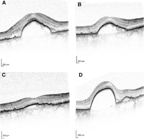 Figure 1 Optical coherence tomography images from eye no 8.