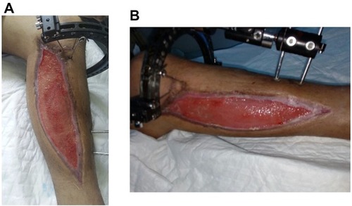 Figure 1 Leg injury after several reconstructive treatments with the applied osteosynthesis device.