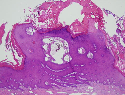 Figure 1. Low power magnification of biopsy showing hyperkeratosis and hypergranulosis with prominent lymphovascular dilatation in the superficial dermis.