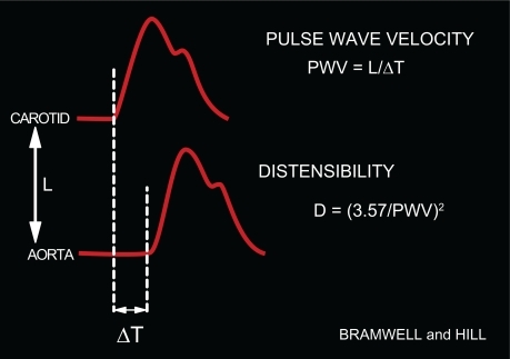 Figure 1 Clinical determination of PWV. PWV is the ratio between: 1) the distance between the carotid and femoral transducers (L), and 2) the time delay (ΔT) between the foot of the carotid and femoral BP curves simultaneously measured. From PWV, distensibility may be deduced.Citation1,Citation2