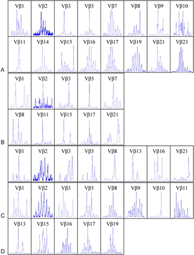 Figure 2. The results of GeneScan of TCR Vbeta subfamilies in PBMCs from four cases with MM. (A) C1 (Stage I), (B) C7 (Stage II), (C) C12 (Stage III), and (D) C13 (Stage III). Clonal expanded T cells could be found in Vbeta3 (A, B), Vbeta5 (A, B), Vbeta8 (C), Vbeta10 (D), Vbeta11 (A, B), Vbeta13 (C, D), Vbeta15 (B) and Vbeta21(C).