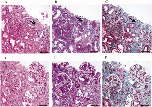 Figure 1. Representative images of the renal biopsy histopathology of IgAN patients with ischemic renal injury (A–C), IgAN patients without ischemic renal injury (D - F); H&E staining (200x). (A, D); PAS staining (200x). (b, e); Masson staining(200x). (C, F).