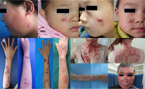 Figure 3 Clinical manifestations of sporotrichosis in patients with chronic cutaneous and subcutaneous lesions in Jilin Province, China (A) Fixed lesions: solitary or satellite erythematosus and papular lesions. (B) Lymphocutaneous lesions: ulcerative/papular/tumor-like lesions distributed along the lymphatic vessels. (C) Disseminated lesions: ulcerative/granulomatous/crusty lesion with multiple cutaneous lesions.
