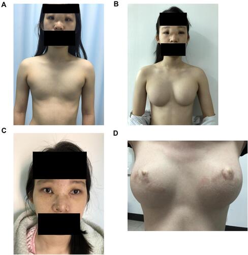 Figure 3 Preoperative and postoperative facial and chest signs of Case 2. (A) Preoperative facial and chest signs of Case 2. (B) Chest sign one year after breast reconstruction. (C) Facial signs one month after eye and nose plastic surgery. (D) Chest sign one year after breast reconstruction.