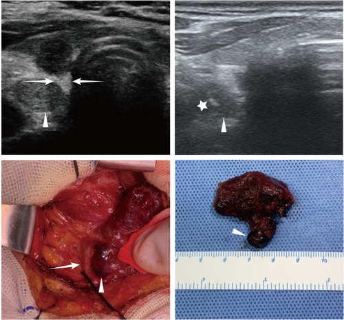 Figure 2 Confirmation of preoperative ultrasound assessment of the recurrent laryngeal nerve (RLN) based on intraoperative detection of adjacent lymph nodes marked with carbon nanoparticles (arrow, RLN; triangle, lymph node; pentagon, injection needle).