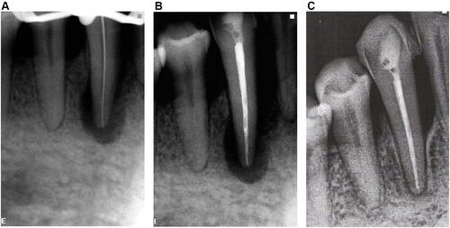 Figure 9 (A) Working length confirmation. (B) Immediately after obturation. (C) Six-month follow-up showing complete healing of the bone defect in the periapical area and interdental septum.