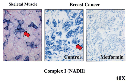Figure 7 Visualizing the anti-mitochondrial effects of Metformin in human breast cancer tumor tissue. Frozen sections from human breast cancers were subjected to mitochondrial Complex I (NADH) activity staining. NADH-positive cells are positively stained blue (see red arrows). In breast cancers, note that the tumor stroma is glycolytic and is NADH-negative, while epithelial tumor cell nests are oxidative and are NADH-positive. Note that treatment with Metformin, a known complex I inhibitor, prevented the NADH-staining of epithelial cancer cell nests. Positive controls with skeletal muscle were performed in parallel to ensure the specificity of the staining procedure and allowed us to detect complex I-positive muscle fibers (blue), which represent oxidative slow-twitch fibers. Reproduced and modified with permission from reference Citation14.