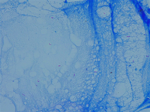 Figure 4 Ziehl-Neelsen special stain revealing acid-fast bacilli (pink rods on a blue background).