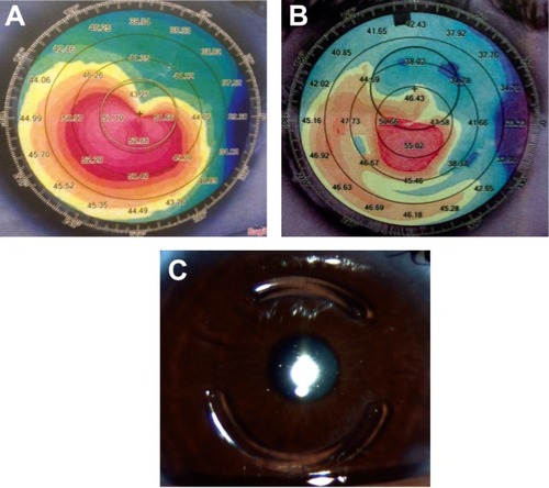 Figure 1 The preoperative (A) and 1-year postoperative (B) appearance of the sagittal anterior map of the Sirius Scheimflug imaging camera (CSO, Italy) of one patient’s right eye after implantation of two Keraring segments (C) followed by transepithelial accelerated corneal collagen cross-linking.