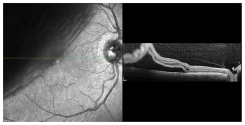 Figure 2 Preoperative optical coherence tomography (OCT) of the right eye of a 53-year-old female with a rhegmatogenous retinal detachment. The macula and the fovea are detached. Preoperative visual acuity (VA) was 20/40. The external limiting membrane (ELM) was preserved, but the inner segment/outer segment (IS/OS) junction of the photoreceptors was disrupted. There is an absence of outer retinal corrugation, but presence of cystoid macular edema. The detachment was surgically repaired with a pars plana vitrectomy. The postoperative OCT revealed a preserved ELM and IS/OS junction. The VA 1-month postoperatively remained 20/40.