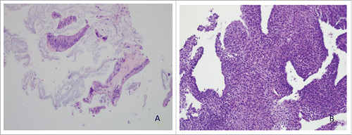Figure 1. (A) Metastatic well-differentiated mucinous adenocarcinoma in liver, H&E, 20x. (B) High grade urothelial carcinoma, H&E, 20x (cell block section, cytology).