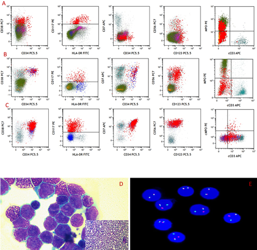 Figure 2 (A and C) Flow-cytometry histograms at different stages. (A) Bone marrow at first diagnosis; (B) bone marrow at times of lymph-node invasion of lymphoblastic T cells; (C) lymph node during lymph-node invasion of lymphoblastic T cells; (D) imprint of lymph-node invasion; (E) interphase FISH results of lymph node during lymph-node invasion of lymphoblastic T cells.