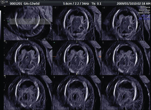 Figure 23.  Holoprosencephaly at 12 weeks of gestation. Tomographic ultrasound imaging shows a single ventricule due to non-separated hemispheres.