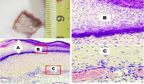 Figure 1 The wound center by the end of the 3rd day after wound modeling, Control group. Hematoxylin–eosin staining. Magnification: X100 (bottom left) and x400 (right). Large scab (A), dense leukocyte infiltrate at the granulation tissue borders and in the scab ((B), magnification x400), leukocytes in scab deep layers, where the congested vessels are dilated ((C), magnification x400).