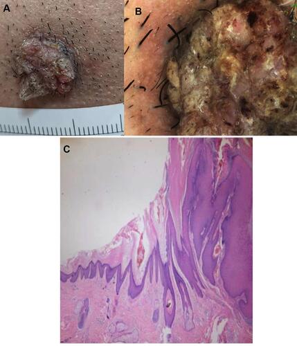 Figure 1 41 years old male with non-classical common wart. Clinical picture (A), dermoscopy (B) and histopathology of the lesion (C).