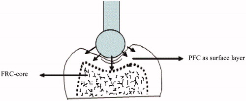 Figure 2. Schematic drawing of a bilayered core-crown restoration and the compression load test setup.