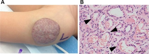 Figure 2 (A) An involuting IH on the arm of a toddler. Note the graying red color when compared to the proliferating IH. (B) Histology: involuting IHs have fewer cells and organized vascular tubular structures (black arrowheads).