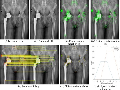 Figure 7. (i–vii) Hip replacement surgery without bone position deviation: (i) Test sample 1a (ii) Test sample 1b (iii) Feature points selection 1a (iv) Feature points selection 1b (v) Feature matching (vi) Motion vector analysis (vii) Object deviation estimation.