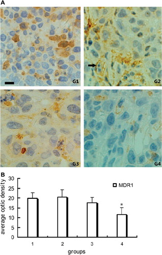 Figure 3. Immunohistochemical staining of MDR1 in tumor tissue: A. Representative pictures of immunohistochemical staining of MDR1 in groups. Positive stain of MDR1 (black arrow). B. Quantitative analysis of average optic density of positive stain in specimen. *P < 0.01 compared with other three groups; scale bar, 25 μm for G1-G4.