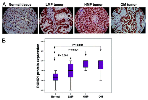 Figure 2. Analysis of RUNX1 expression in serous EOC tumors by IHC. (A) Representative IHC images of RUNX1 protein expression in normal ovarian tissues, LMP tumors, high-grade tumors and omental metastases. (B) Box-plot presentation of RUNX1 protein expression levels in normal ovarian tissues, LMP tumors, high-grade tumors and omental metastases.